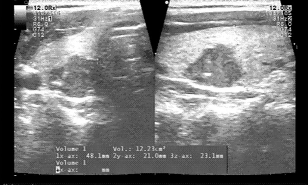 Ultraschall Untersuchung Schilddrüsenkarzinome im MVZ Mainz Prof. Dr. Dr. Wüster